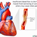 Angina Blockage