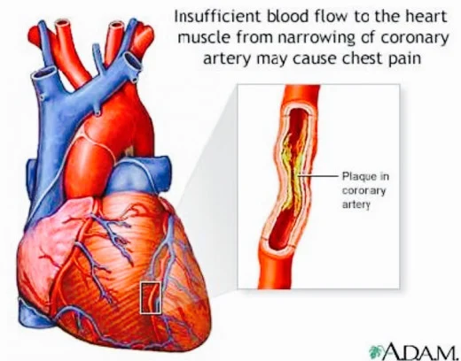 Angina-Pectoris-is-caused-by-a-poor-blood-flow-to-the-heart